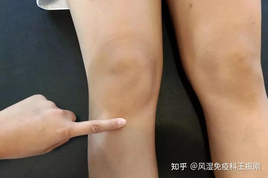 膝前痛不一定是膝骨关节炎也可能是髌下脂肪垫炎看看有啥特点