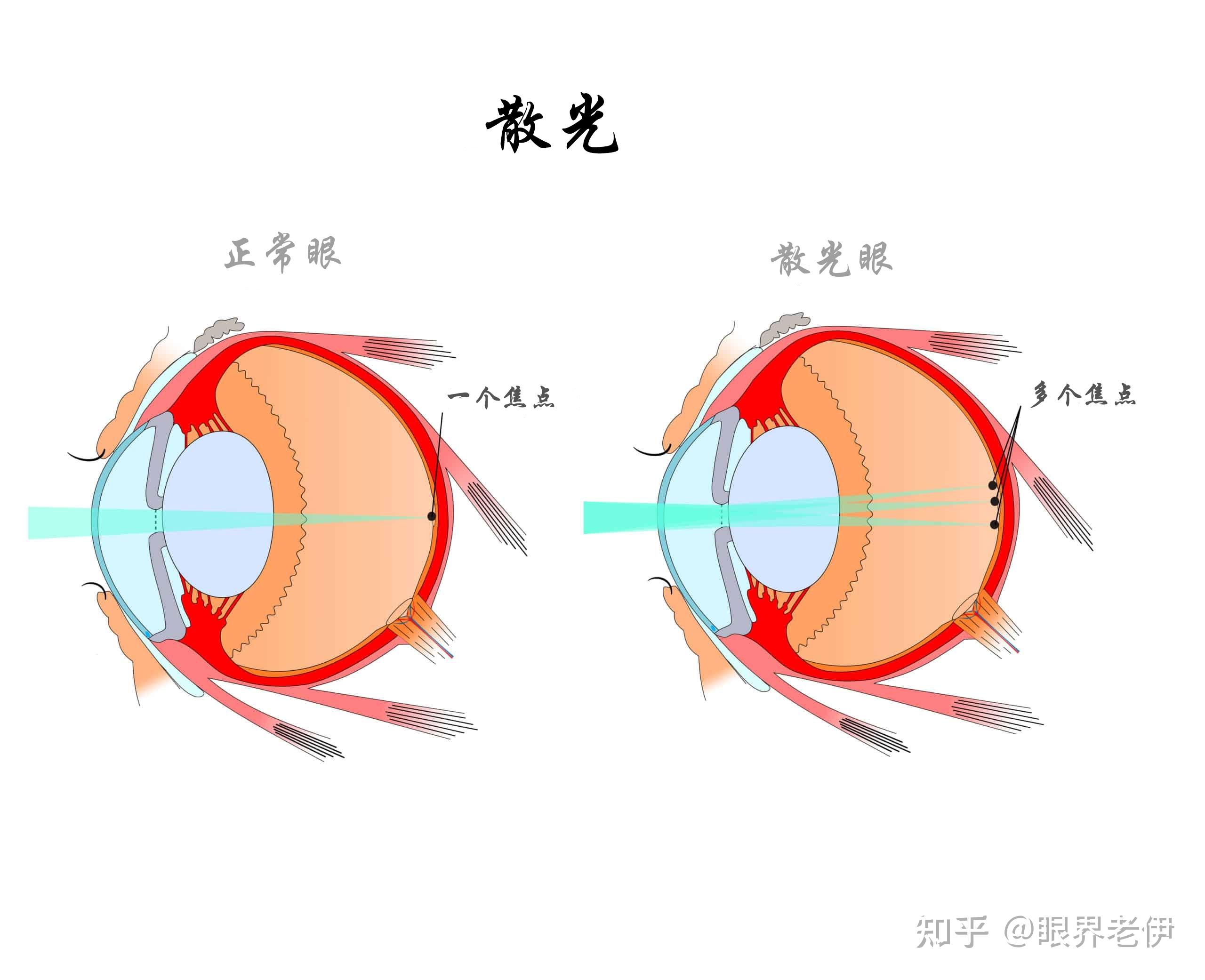 散光可以做近视手术吗? - 知乎