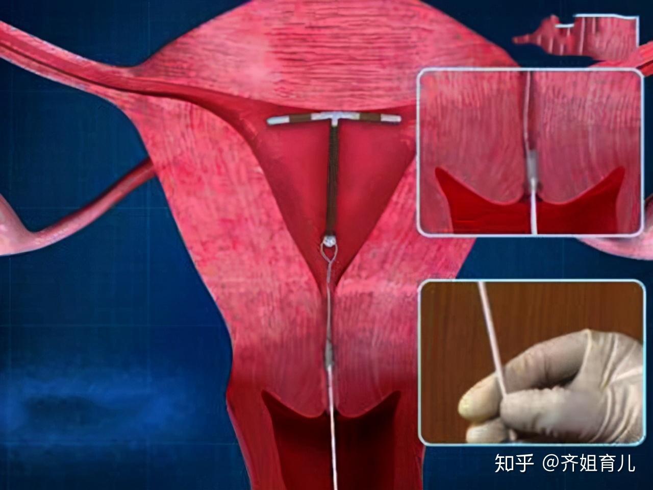 节育环在宫腔内的图片图片
