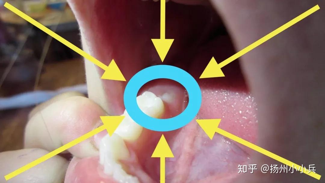 六齡牙是兒童在6歲左右萌出的第一顆恆磨牙,它是恆牙列的支柱牙,承擔