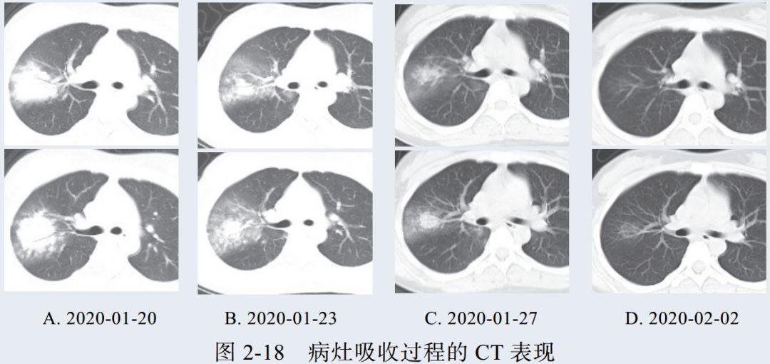 新冠肺炎ct早期征象与鉴别诊断 知乎 4994