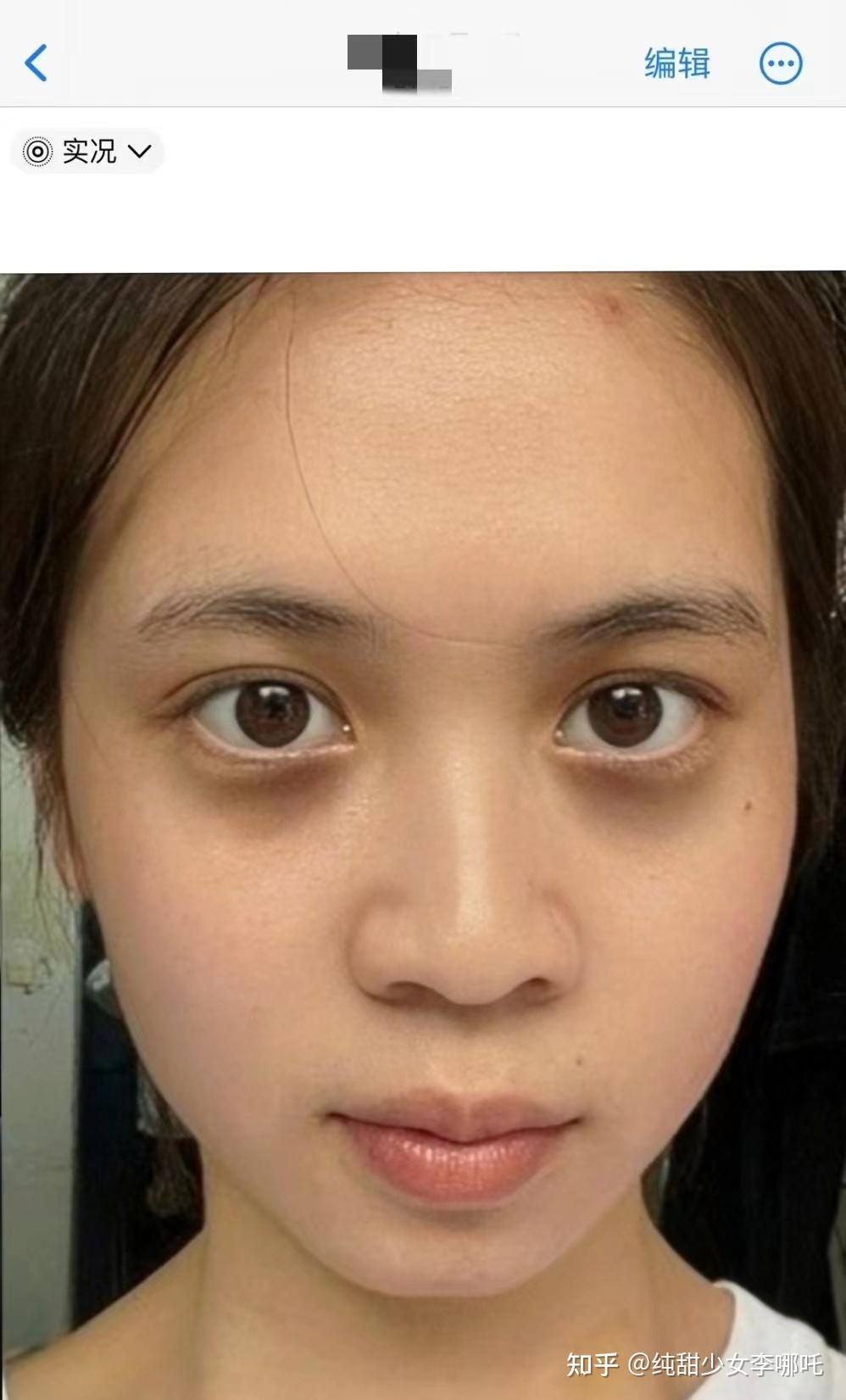 黑眼圈特别重,天天睡八个小时也淡不了,该怎么办?