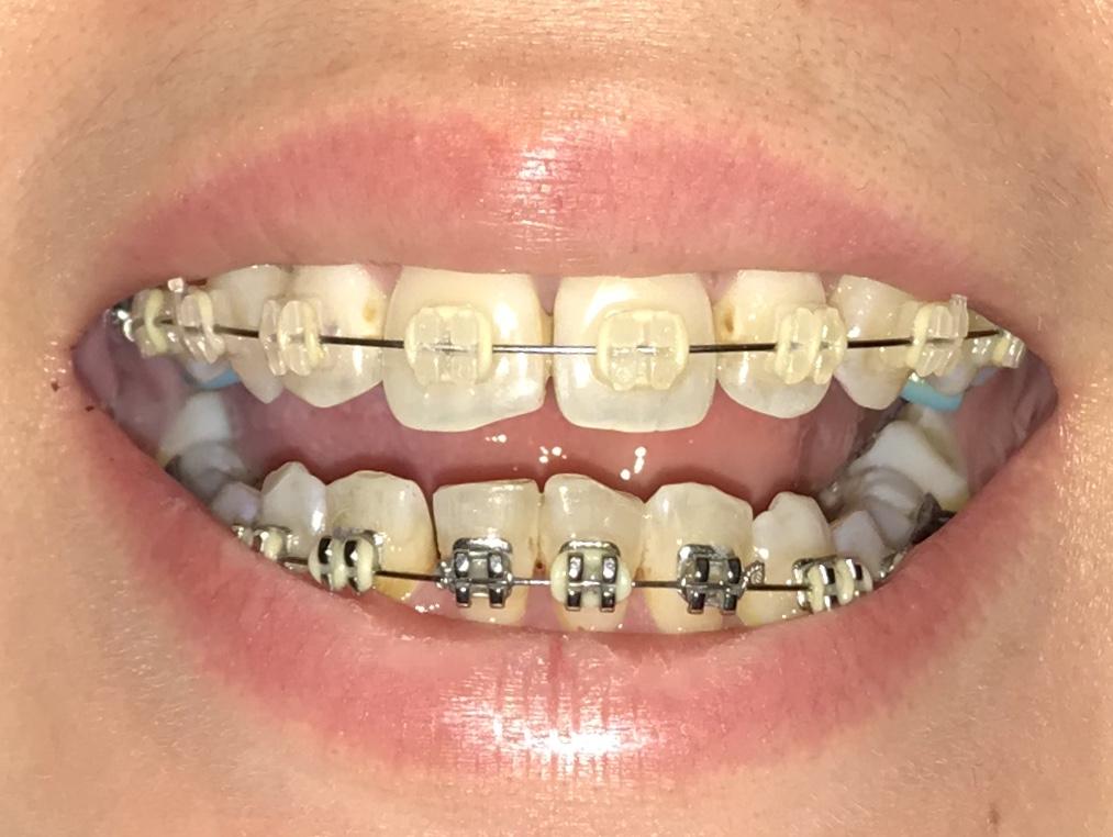 有30多岁开始牙齿矫正的吗?正畸效果怎样?会