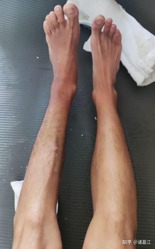 打篮球脚踝严重扭伤了怎么办