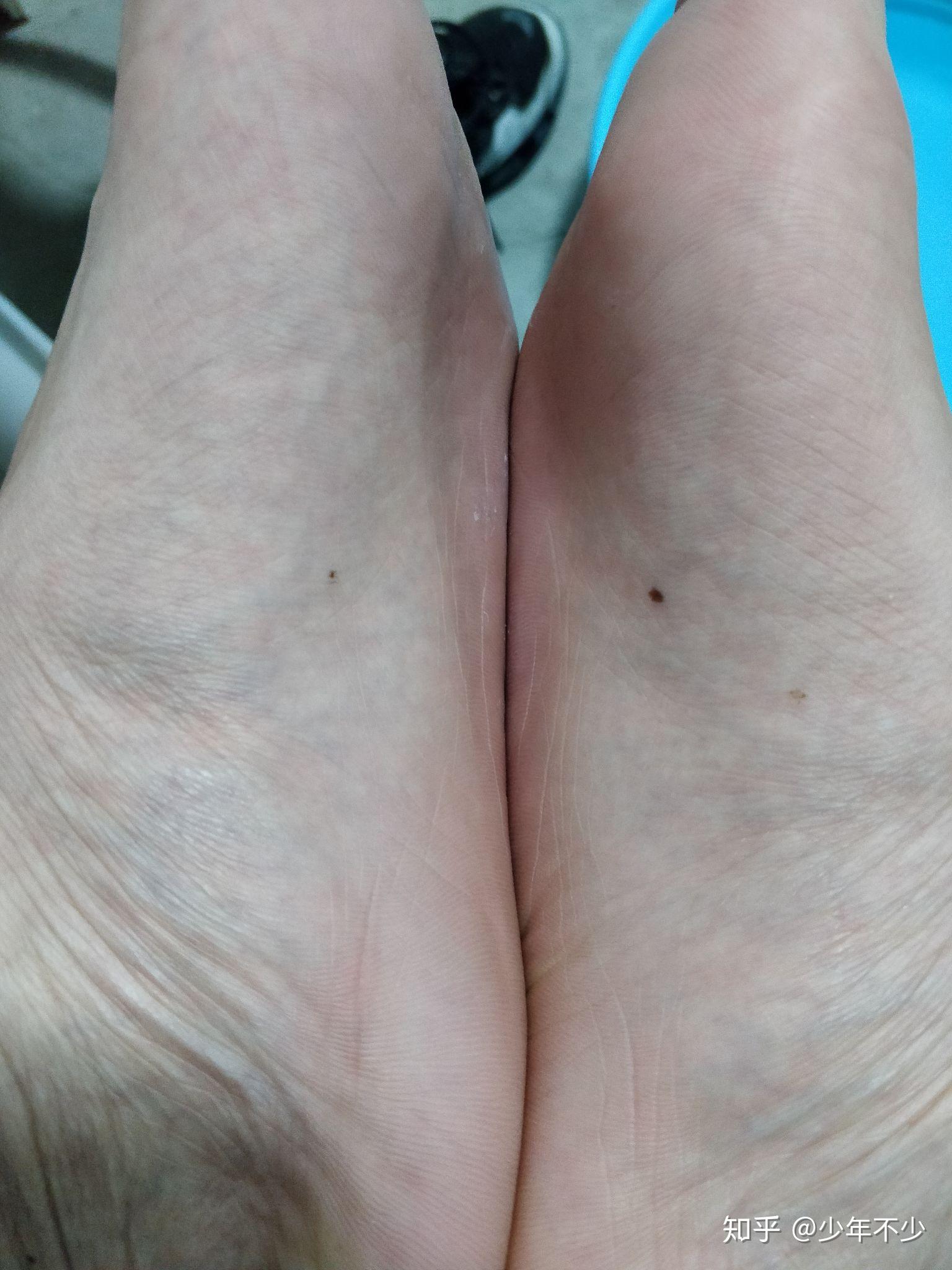 脚底板长了一颗痣 知乎