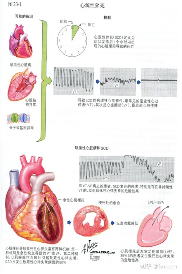 博声医疗:心源性猝死 - 知乎