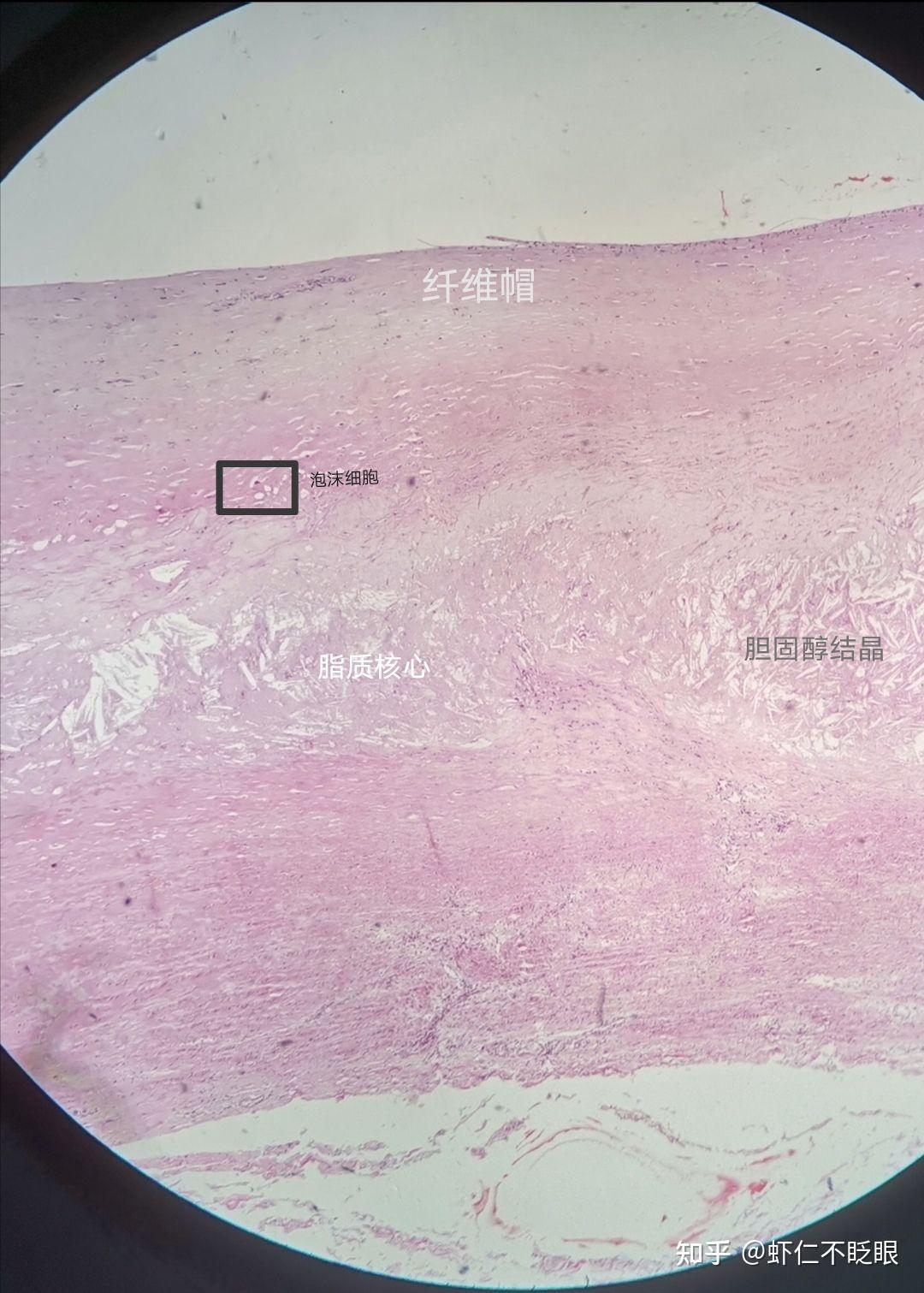 病理学切片及描述 - 知乎