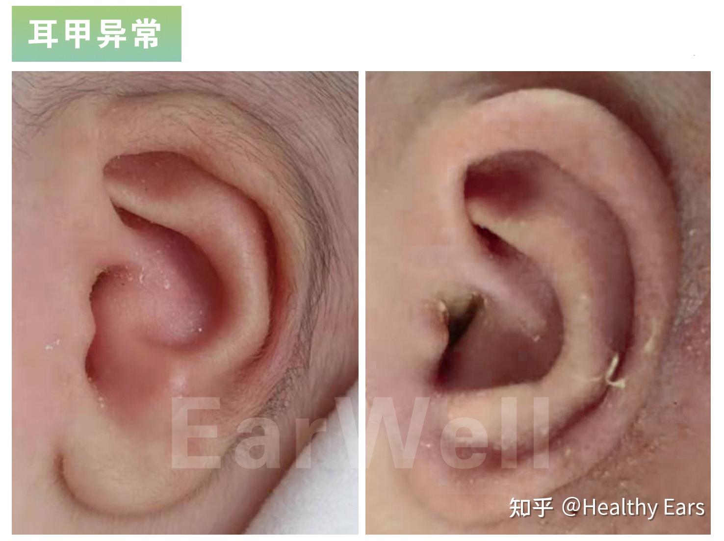 新生儿耳甲腔凸起图图片