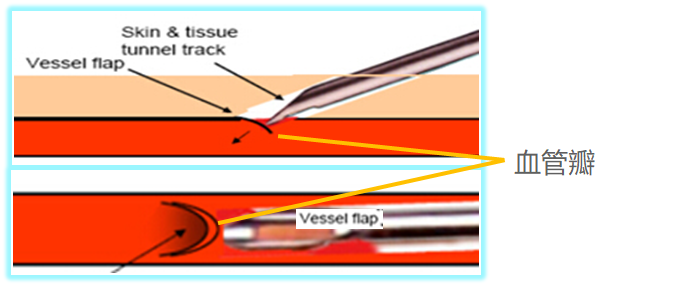 自体动静脉内瘘扣眼穿刺点的超声表现