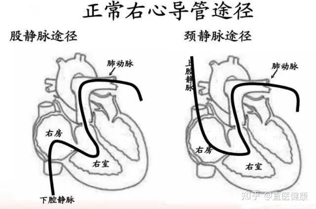 临床上针对肺动脉高压主要采用实验室检查,超声心动图检查,心电图,肺