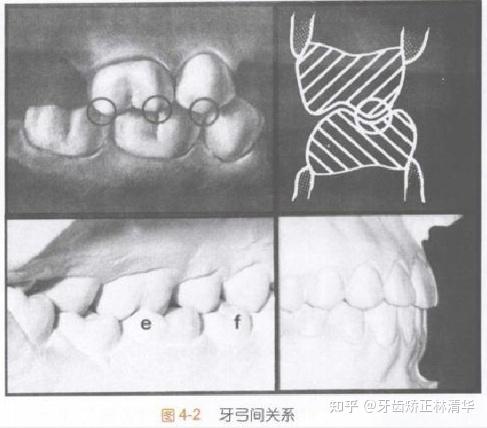 个别正常牙合