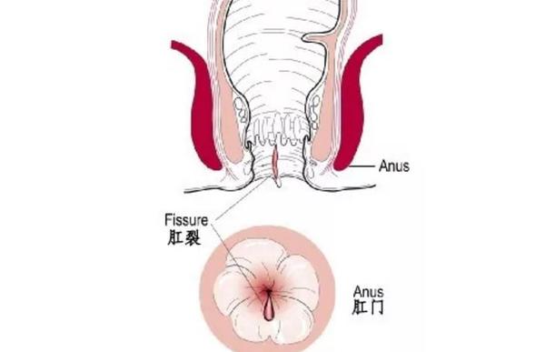 肛裂反复发作 晚期需要手术 早期还有办法 知乎