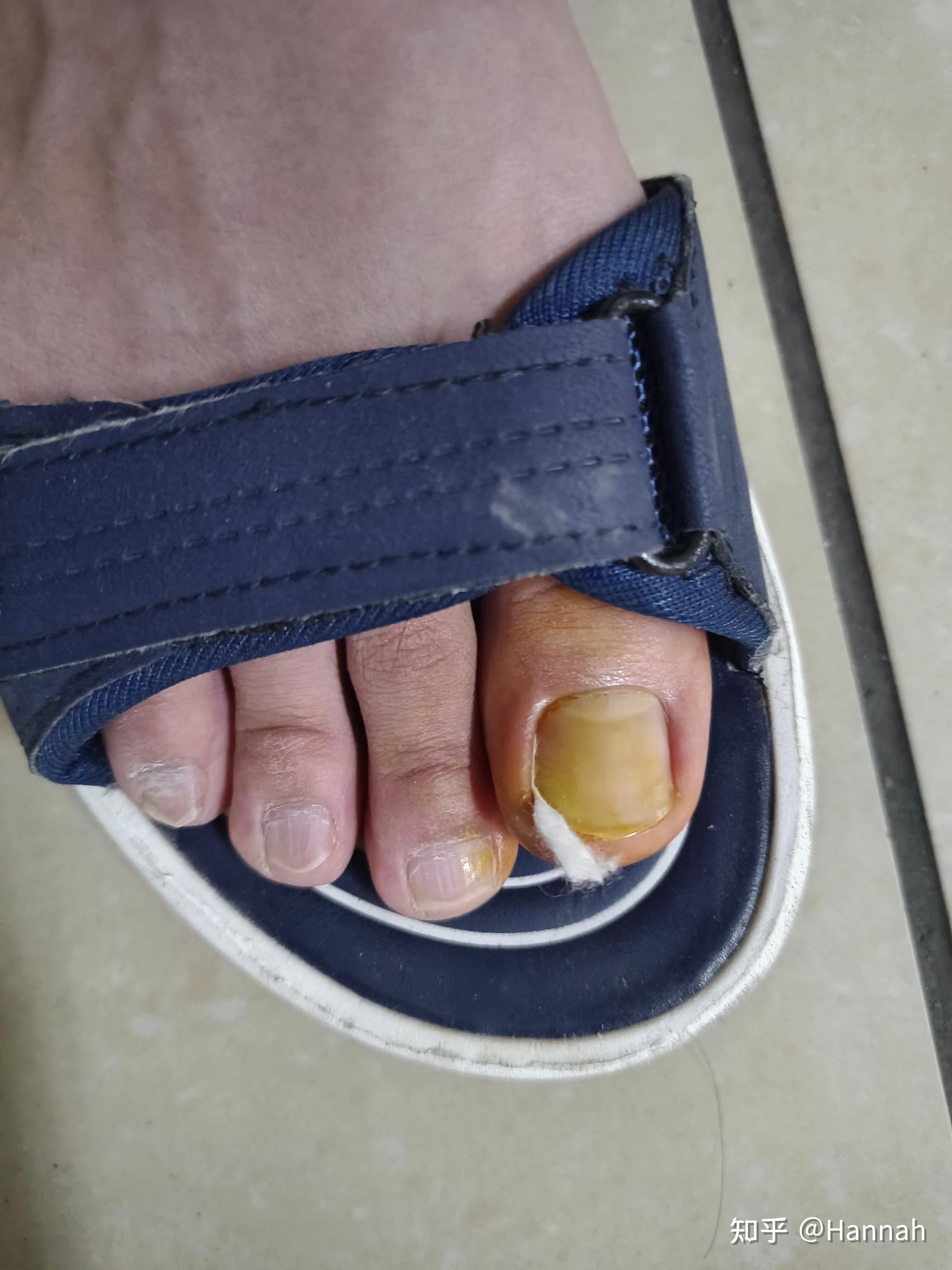 17岁青少年甲沟炎治疗记