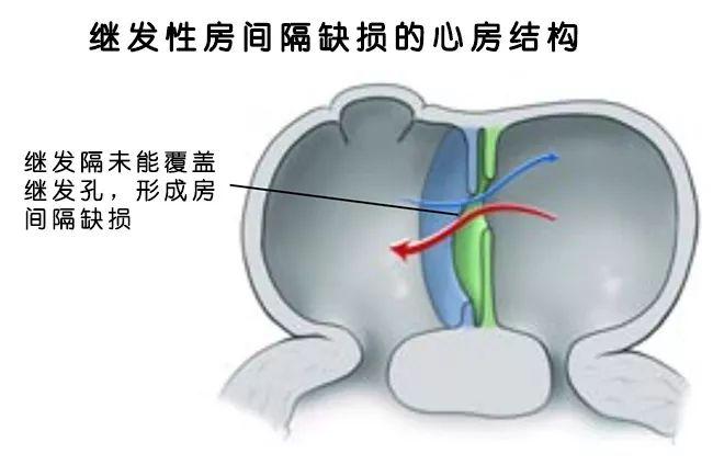 先心病房间隔缺损多大必须手术? - 知乎