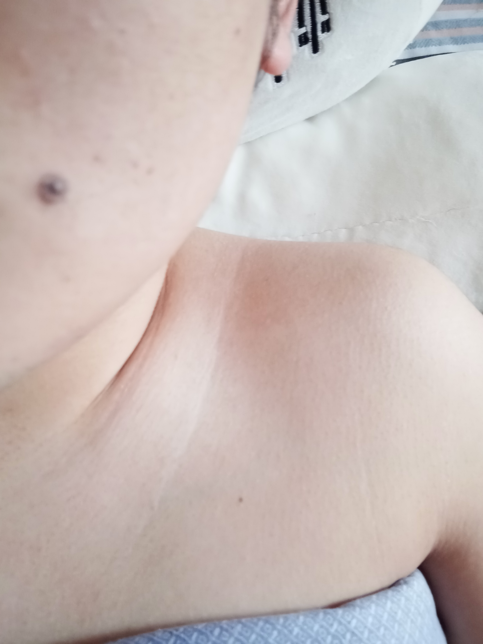 液氮点痣记录贴