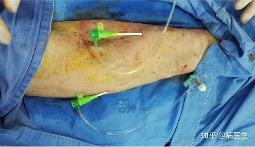 avg血栓介入治疗——超声引导下导管溶栓 球囊扩张(一) - 知乎