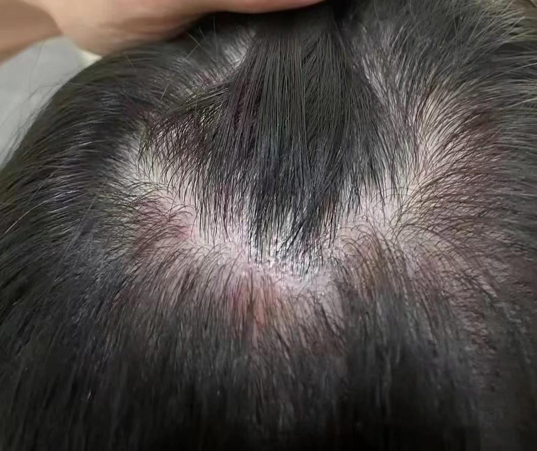 就是典型的油脂性脱发造成的毛囊炎!