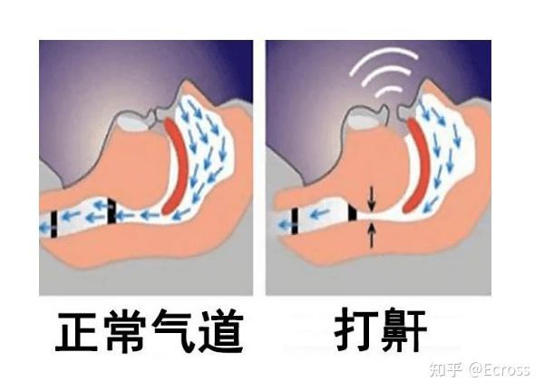 别把打鼾不当回事 - 知乎