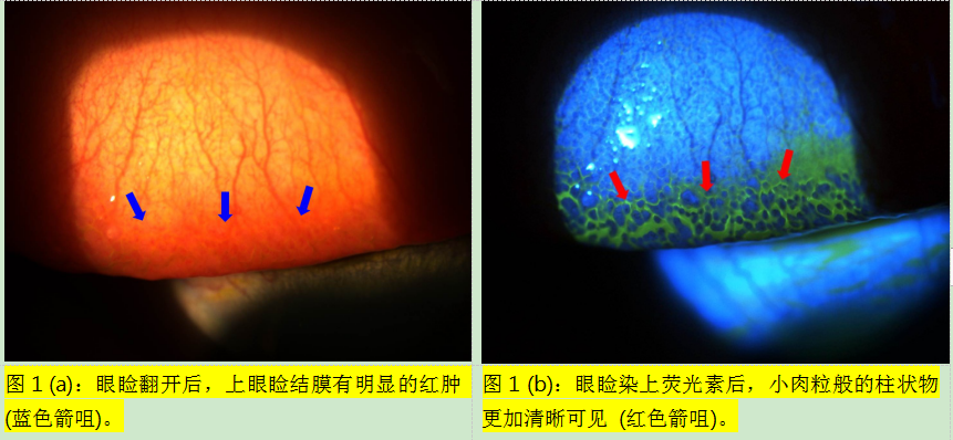 隐形眼镜蛋白质沉淀图图片