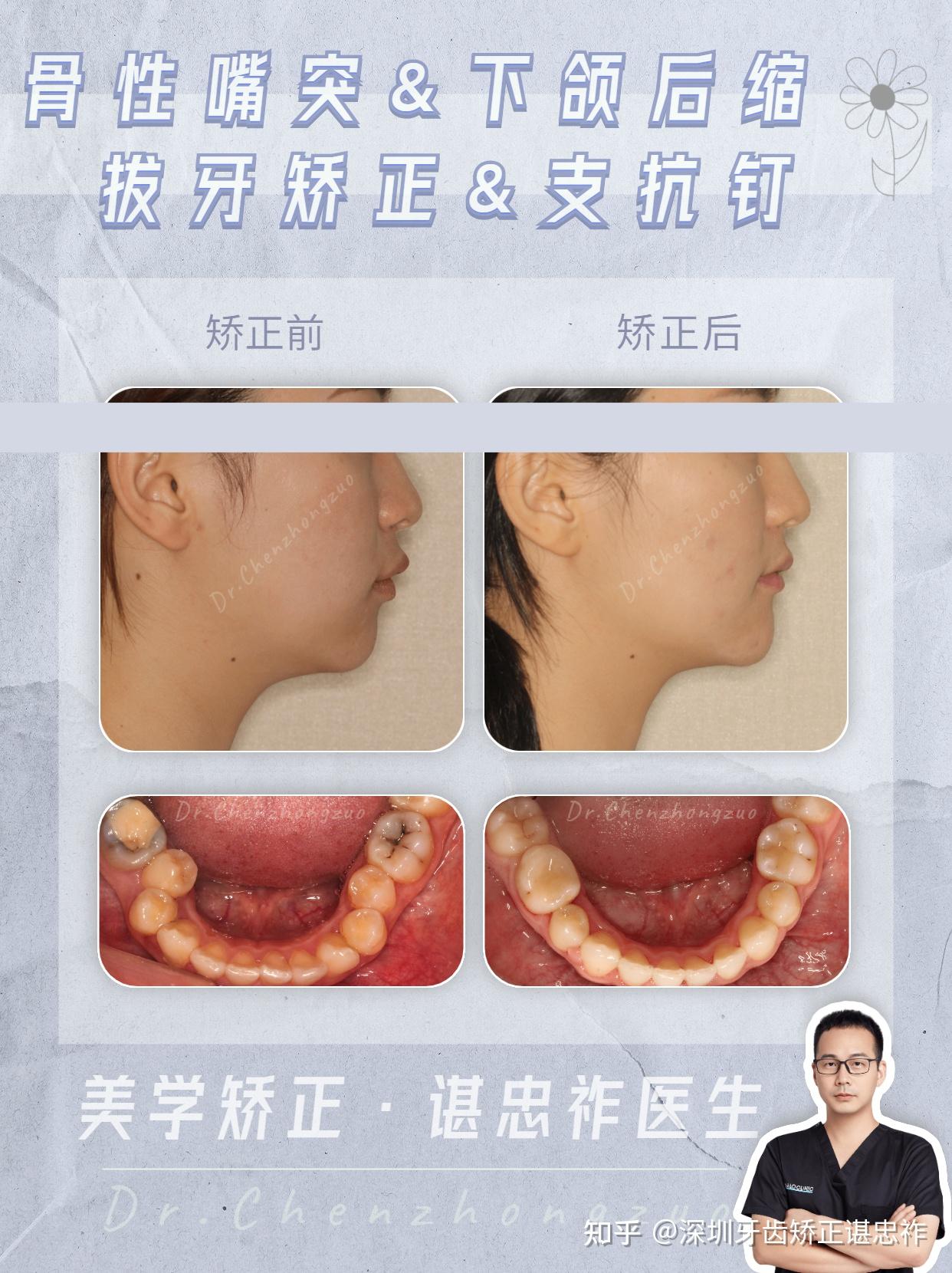 深覆合矫正脸型图片