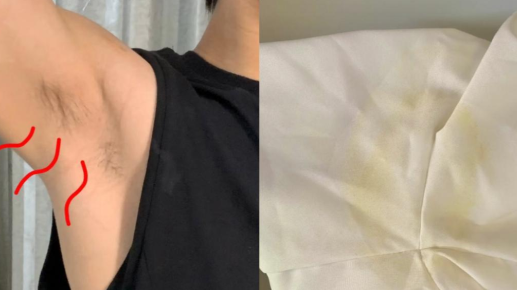 狐臭专区男生身上有狐臭被嫌弃狐臭到底怎么去除皮肤科