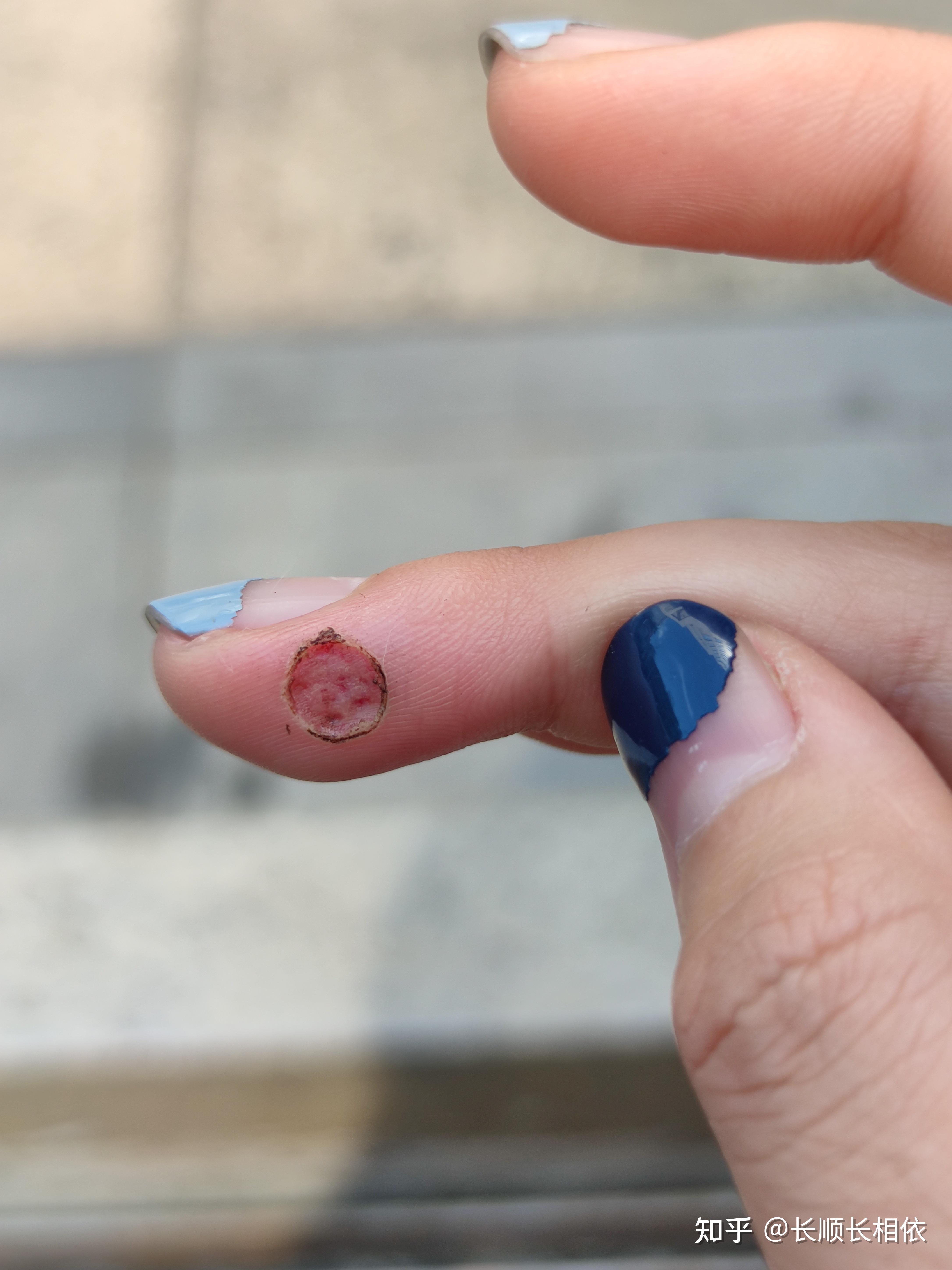 激光去除手指病毒疣记录 复发 - 知乎