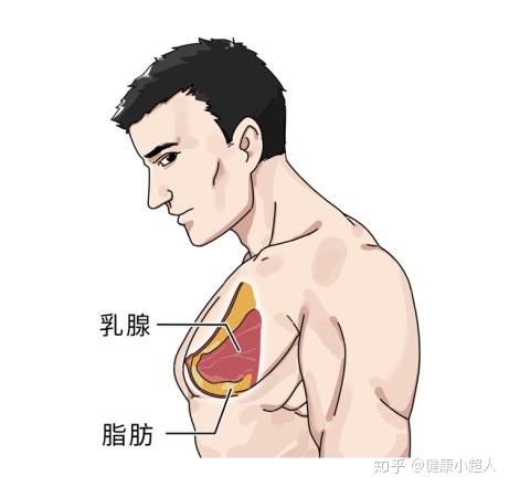 直接放置硅胶假体男性隆胸不能按女性的路子胸部皮肤紧,肌肉发达因为