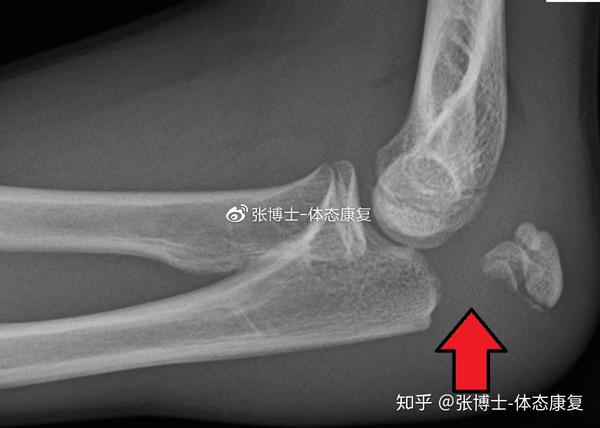 运动康复科普 肘关节损伤的常见类型与急性处理方法 知乎