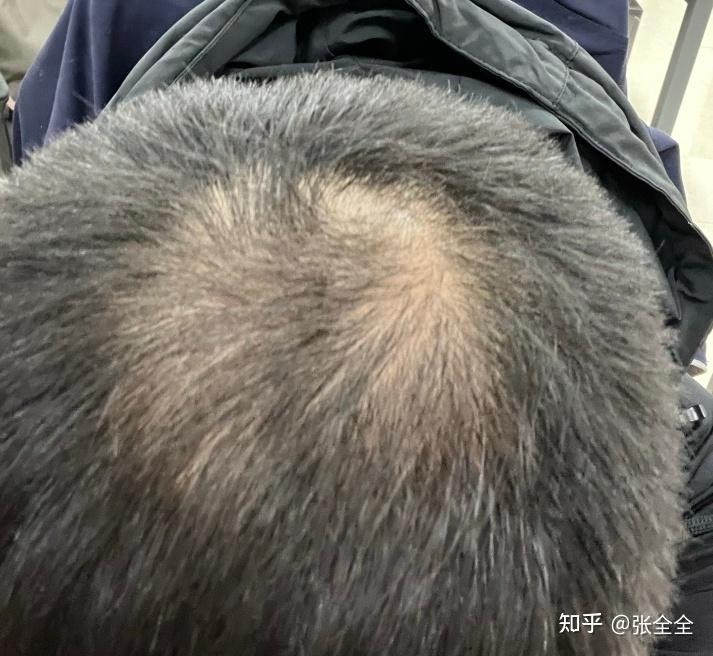 滚针治疗脱发 - 知乎