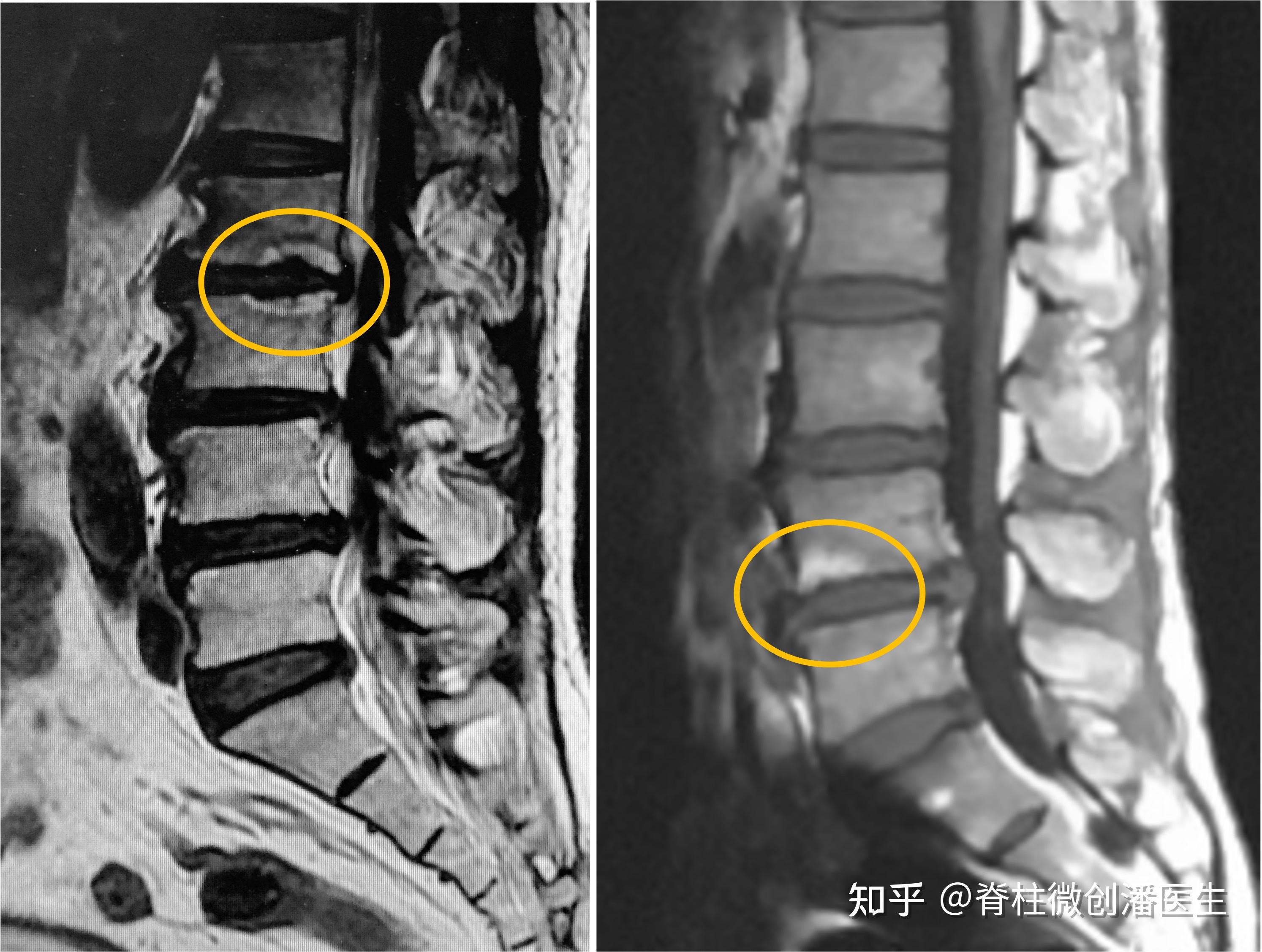 磁共振报告上写的终板炎是感染了吗?与腰痛有关系吗? - 知乎