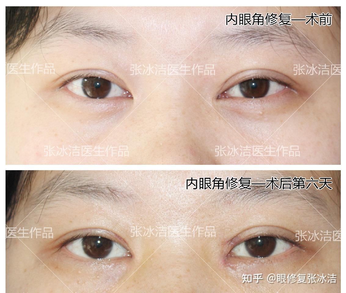 介绍无切开自然、利用非切开双眼皮手术的眼部修复手术方法 [自然粘连双眼皮+非切开眼眸矫正+开内眼角] - 知乎