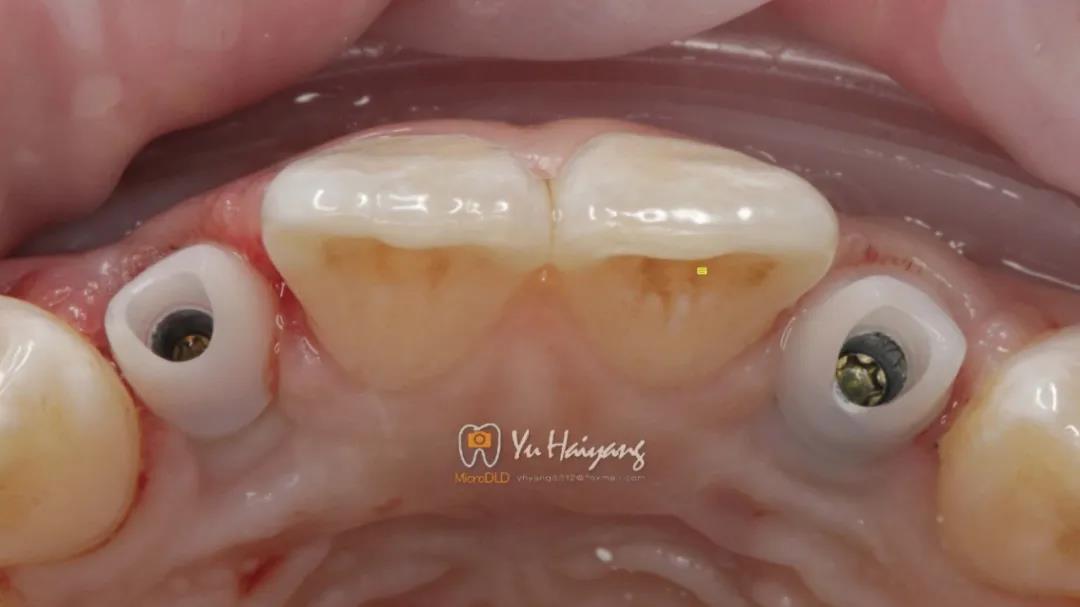 正畸牵引联合氧化锆基台修复双侧侧切牙缺失1例