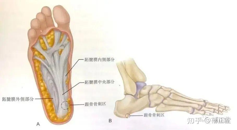 足底筋膜炎解剖图图片