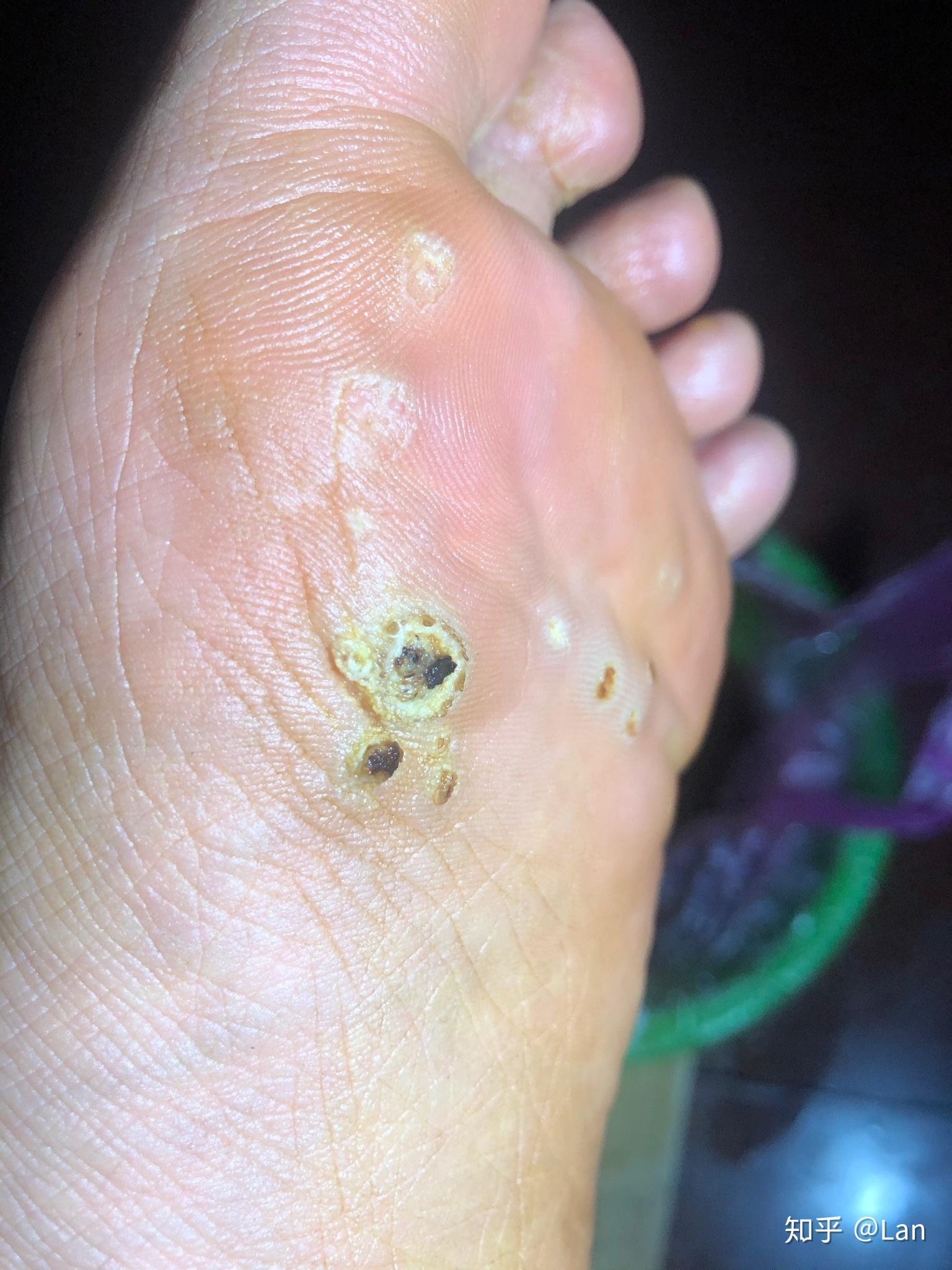 火针治疗跖疣一点感受