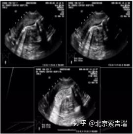 宫腔粘连的诊疗要点,快速梳理! - 知乎