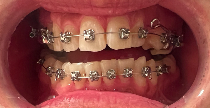 今天去复诊给上排牙齿换了弓丝,换了牵引埋伏牙的弹力线,下排牙没动.