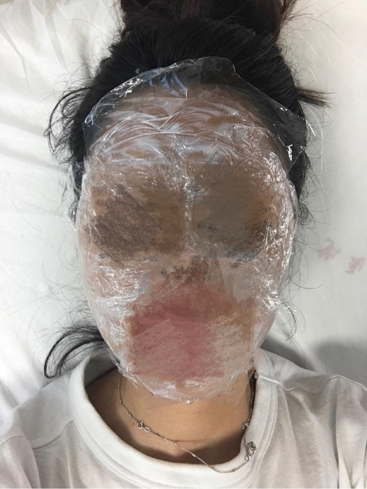 点阵激光去痘坑的效果如何?