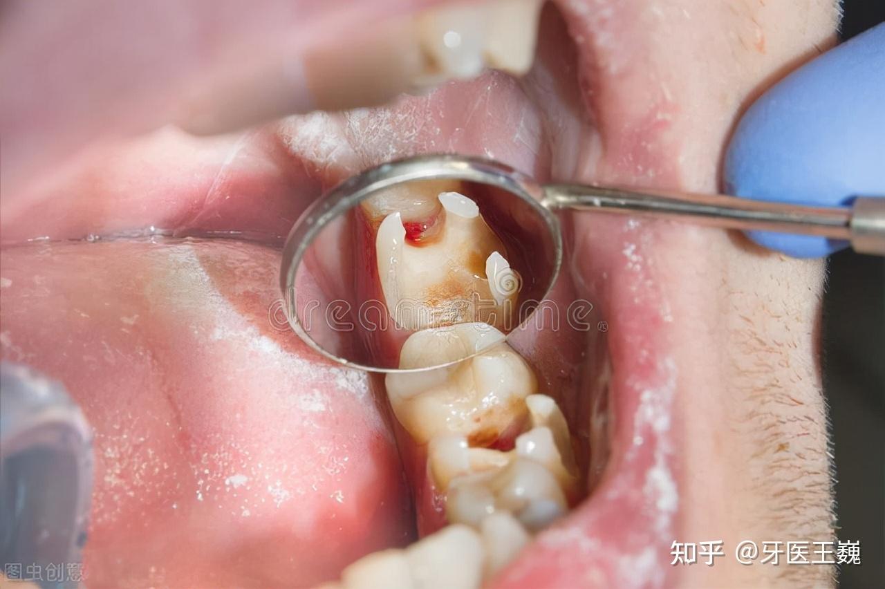 牙齿深龋/树脂直接填充 - 知乎