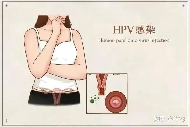 女人感染hpv52图片图片