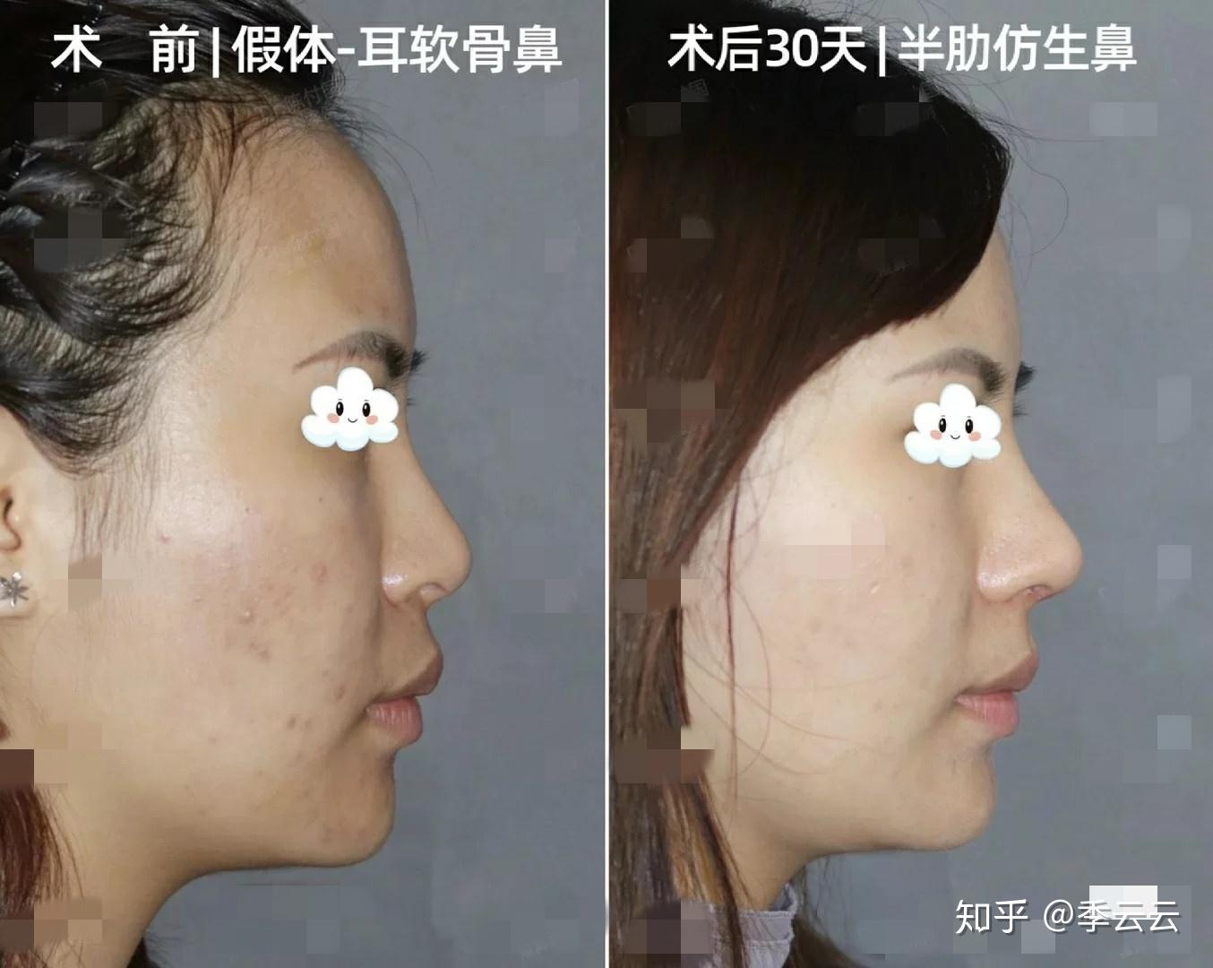 韩国李丙玟隆鼻失败修复实例,验证李丙玟做高难度鼻修复好,鼻部对比照-8682赴韩整形网