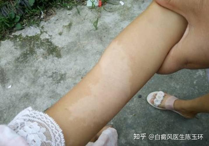辨别早期白癜风的方法有哪些