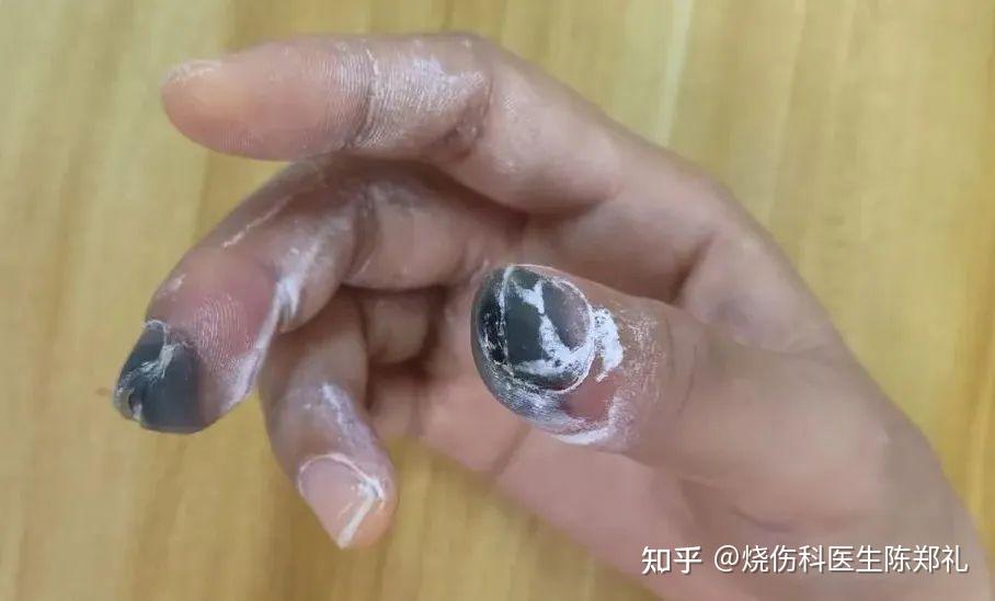 除了烧烫伤,烧伤科还能看什么病? - 知乎
