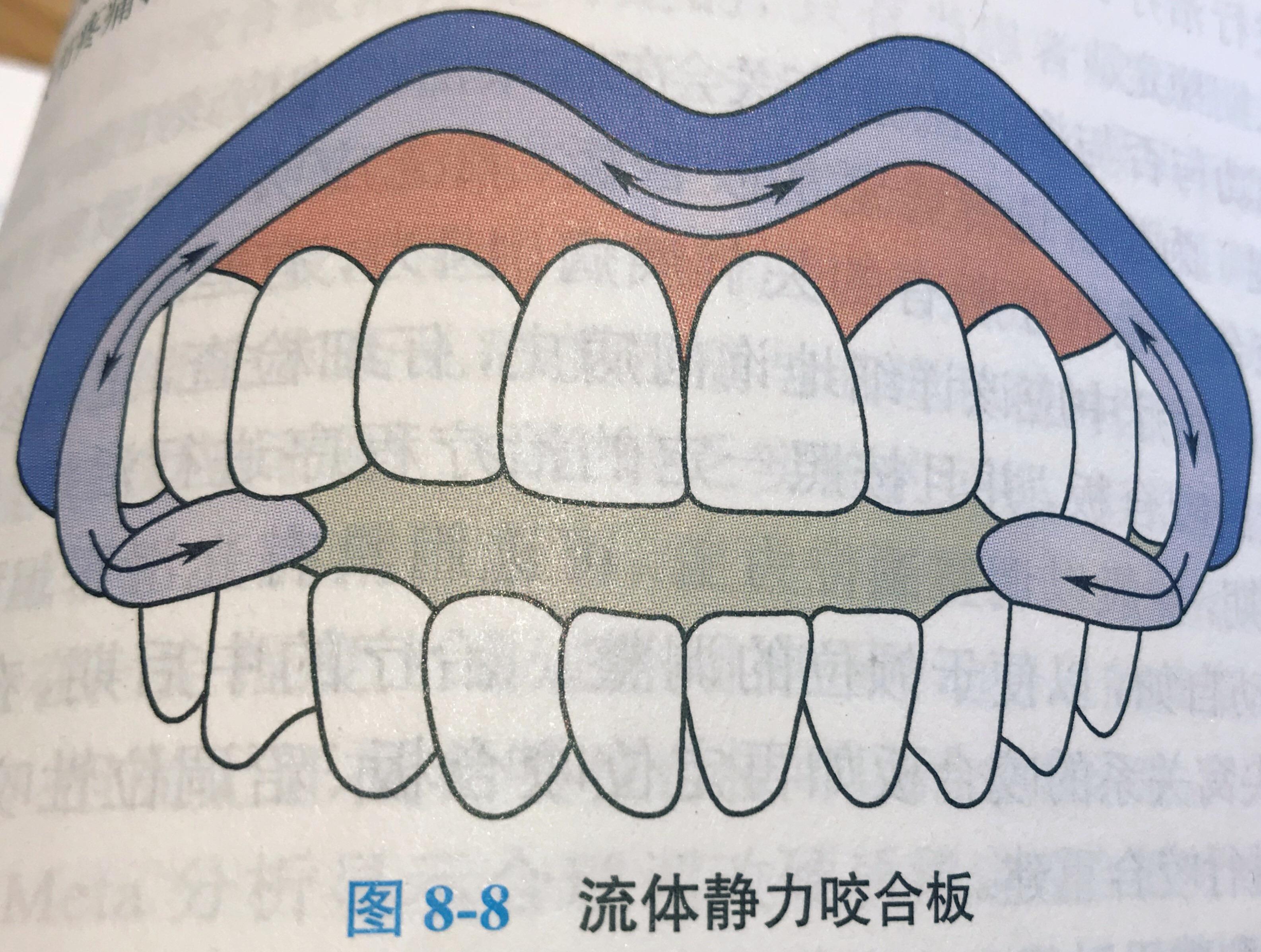 nti-tss splint)是一種新型已商業化應用的咬合板,它僅覆蓋上頜中切牙