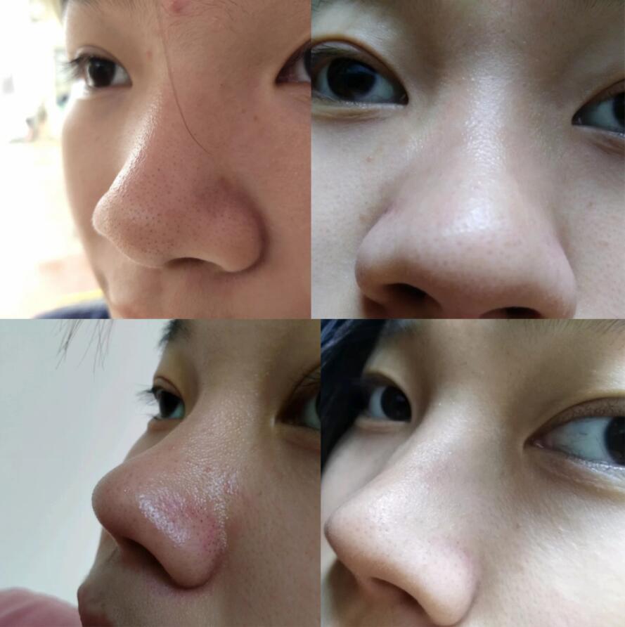 米粒大的黑头在鼻子上真的太丑了!怎么才能解决?