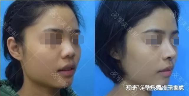 如何变成高鼻梁女生 v2-ed8bf309bdc8ef46ecb8ecc094b6397c_r.jpg