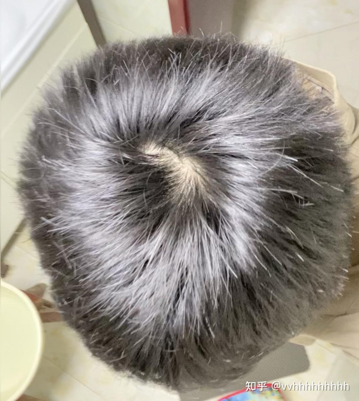 什么样子的发旋是正常的啊