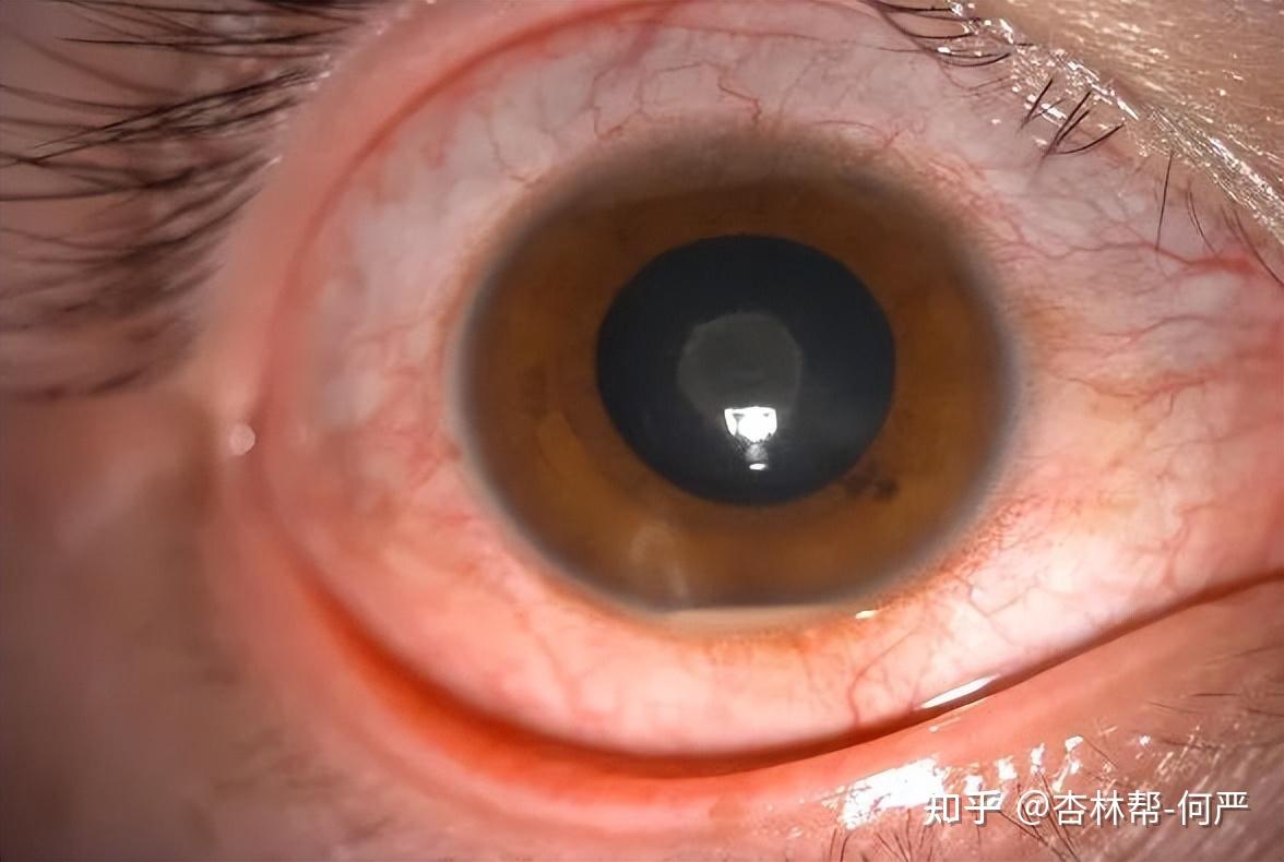 关于眼红你不知道的那些事