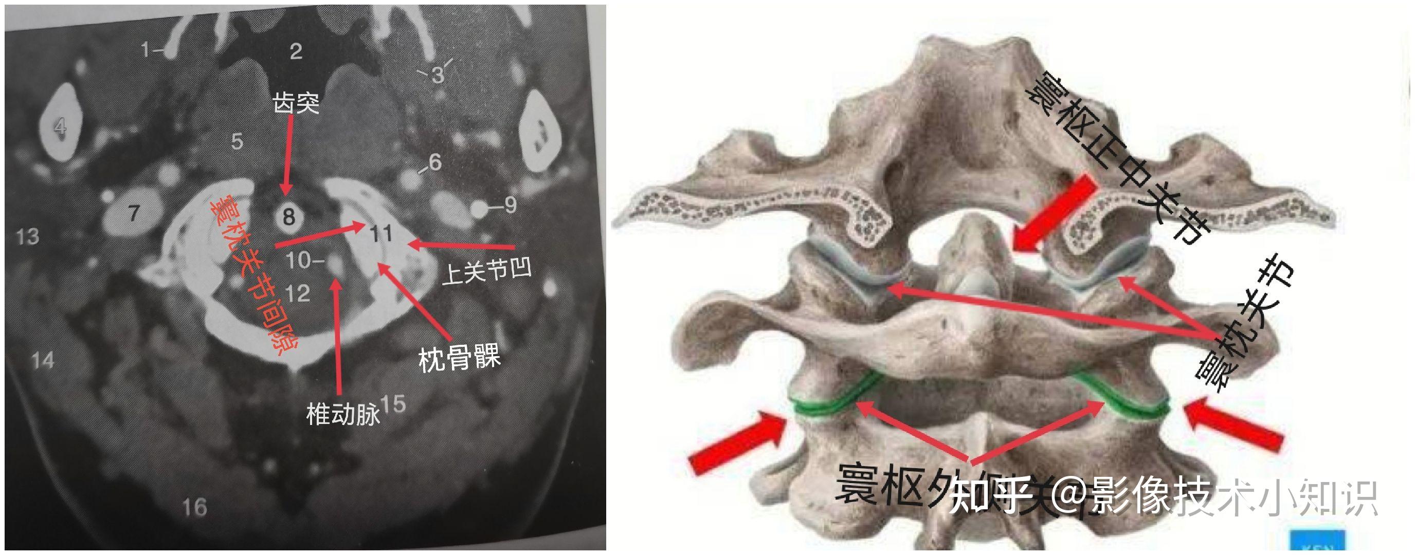 脊柱CT解剖 - 知乎