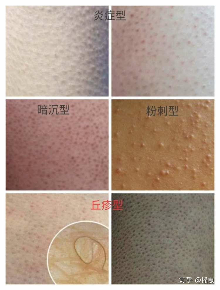 有去除鸡皮肤的好产品吗(有去除鸡皮肤的好产品吗女生)