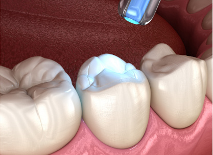 树脂补牙